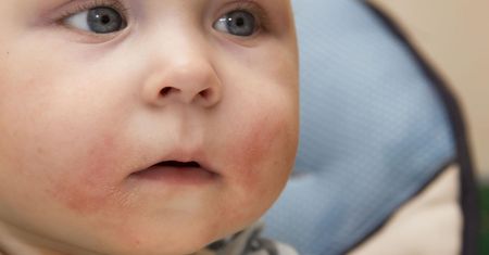 Alergia na gluten u niemowląt
