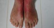 Wystarczy spojrzeć na stopy. Ten objaw zawsze wzbudza czujność lekarzy