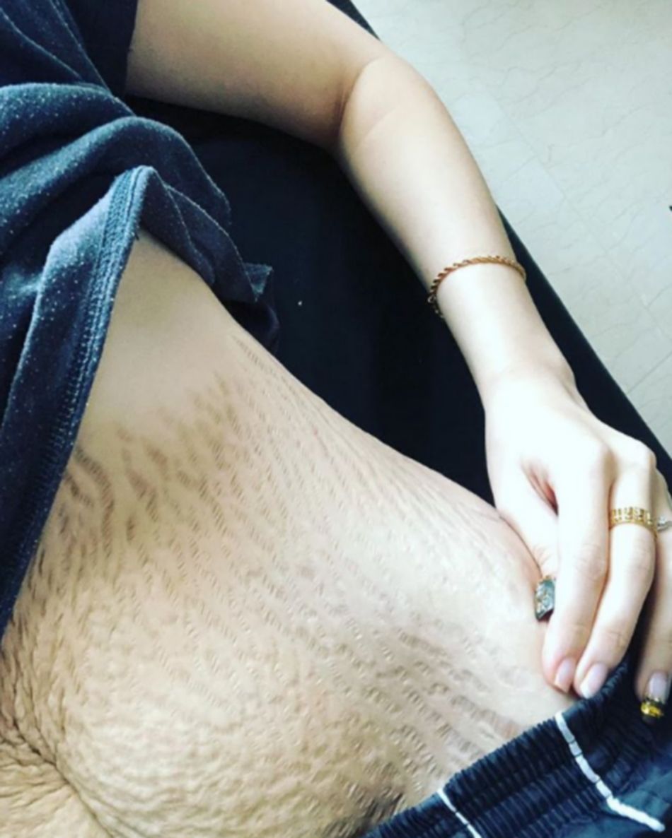 Dziewczyna opublikowała zdjęcie brzucha po ciąży