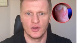 Niechciana pamiątka z wakacji. Lekarz ostrzega przed "czerwoną nitką pod skórą"