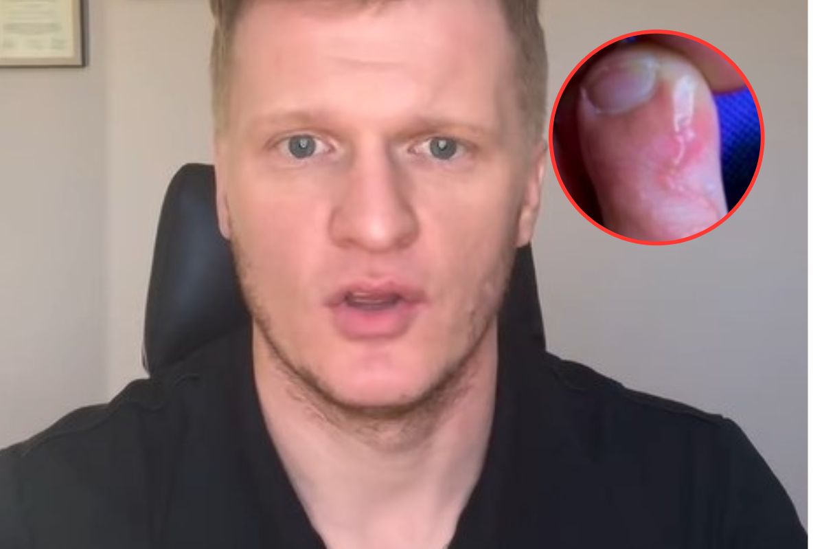 Niechciana pamiątka z wakacji. Lekarz ostrzega przed "czerwoną nitką pod skórą"