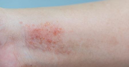 Diagnostyka alergii pokarmowej