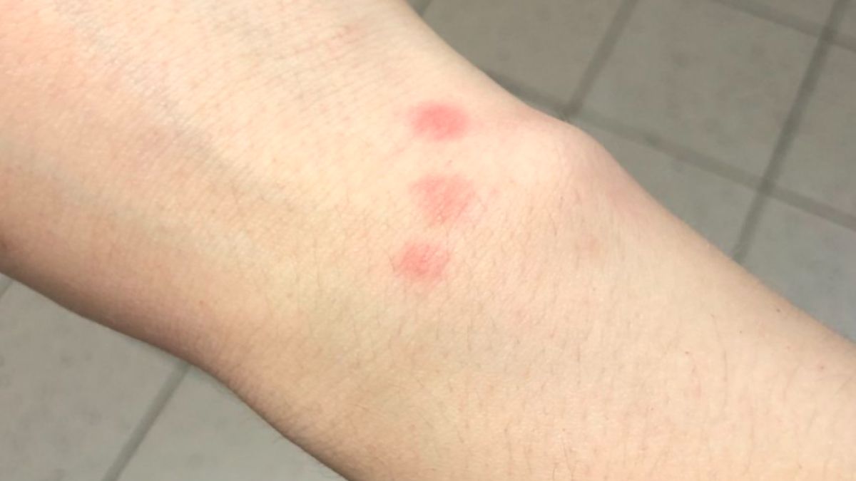 Meszki dają się we znaki. Ich ugryzienie wywołuje świąd, opuchliznę, a czasem silną reakcję alergiczną.