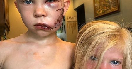 6-latek uratował siostrę. Teraz wygląda zupełnie inaczej