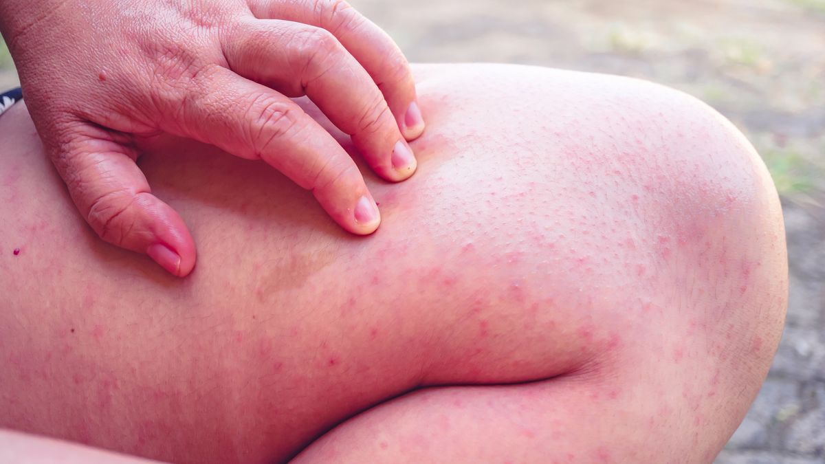 Human skin with red blisters, Close-up of human skin with varicella papules or papules due to certain viral infections., Measles
Human skin with red blisters, Close-up of human skin with varicella papules or papules due to certain viral infections., Measles
Singjai20