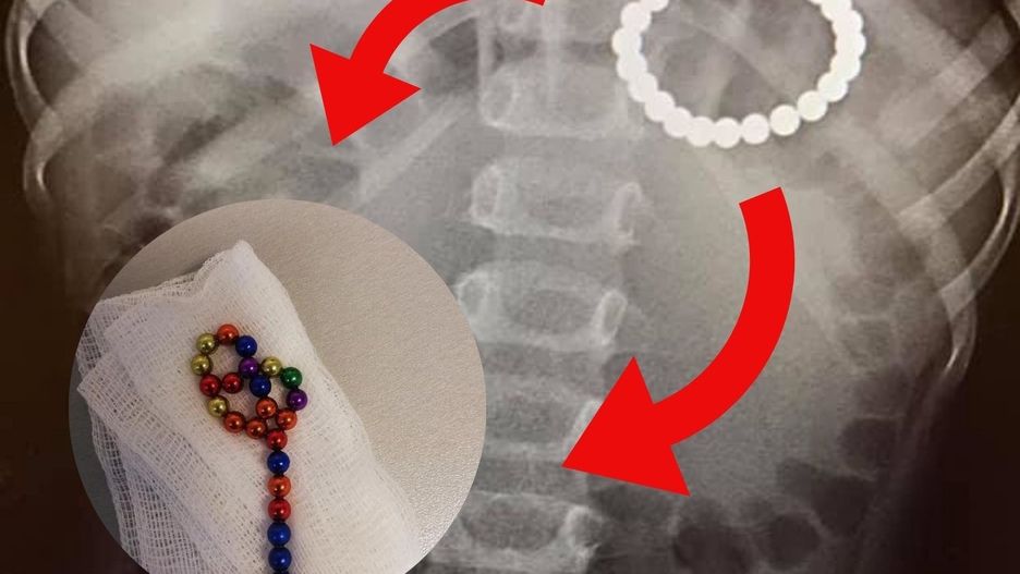 Lekarze wyciagnęli z brzucha dziecka magnesowe kuleczki