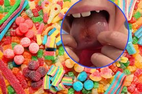 Kwaśne cukierki poparzyły język chłopca. Matka ostrzega
