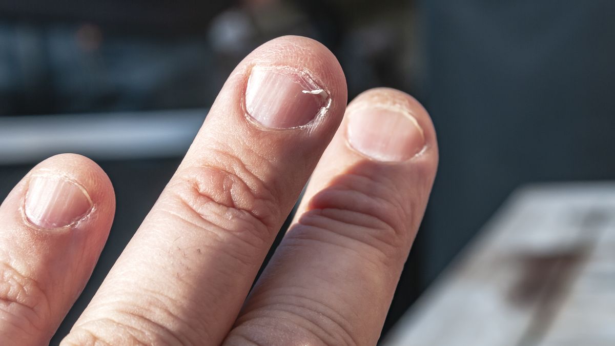 Łamliwe paznokcie mogą być objawem braku witaminy C