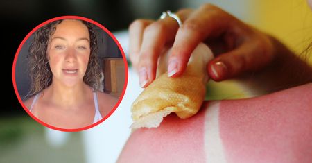Kefir to już przeżytek. Co na oparzenia słoneczne?