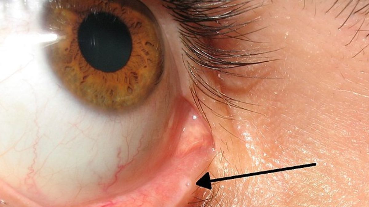 Oko z punktem łzowym