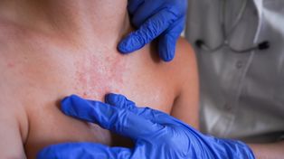 34 tys. zakażeń na odrę. WHO: Szczepionka chroni na całe życie