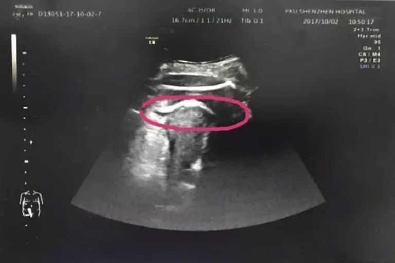 (Peking University Shenzhen Hospital) Zdaniem lekarzy nienarodzona wtedy córka tak mocno kopnęła w ścianę macicy, że ta nie wytrzymała i pękła