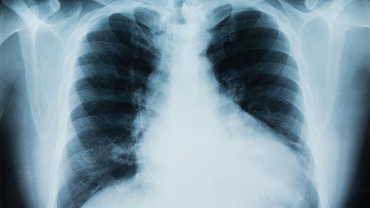 Rak płuc to jeden z najgorzej rokujących nowotworów