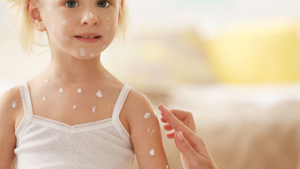 Ospa dzień po dniu – ile trwa choroba?