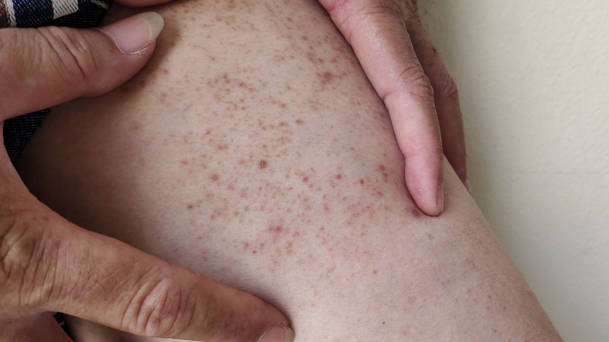 Sepsa zabija co 5. osobę na świecie