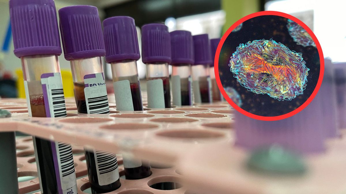 Pierwszy przypadek poważniejszego typu mpox w Szwecji