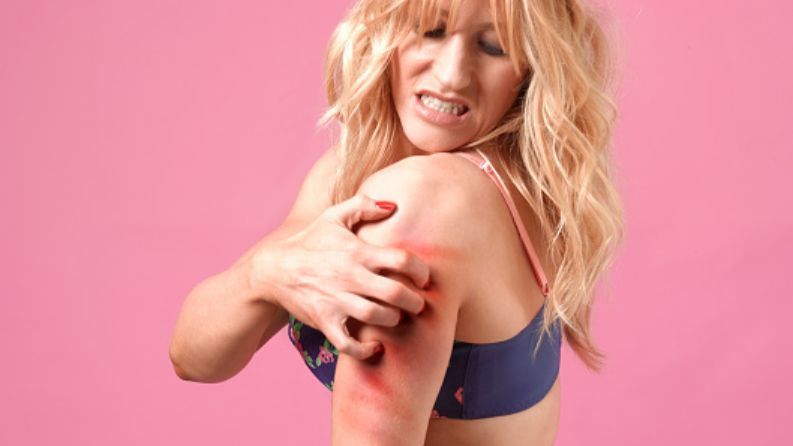 Dermatillomania to neurotyczne lub też patologiczne drapanie zdrowej skóry.