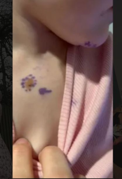 Zmiany barwnikowe zaniepokoiły Helen