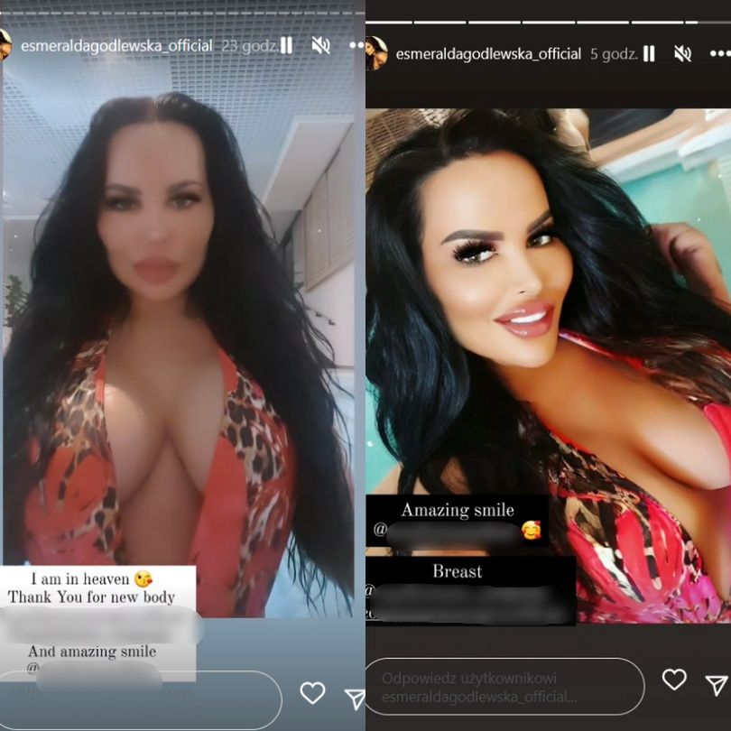 Esmeralda Godlewska chwali się efektami zabiegów w tureckiej klinice