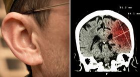 Naukowcy: wystąpienie udaru może zależeć od kształtu ucha