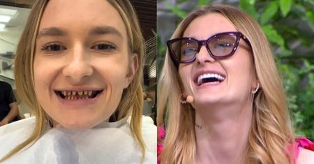 Zrobiła sobie "tureckie zęby". Dentyści łapią się za głowę