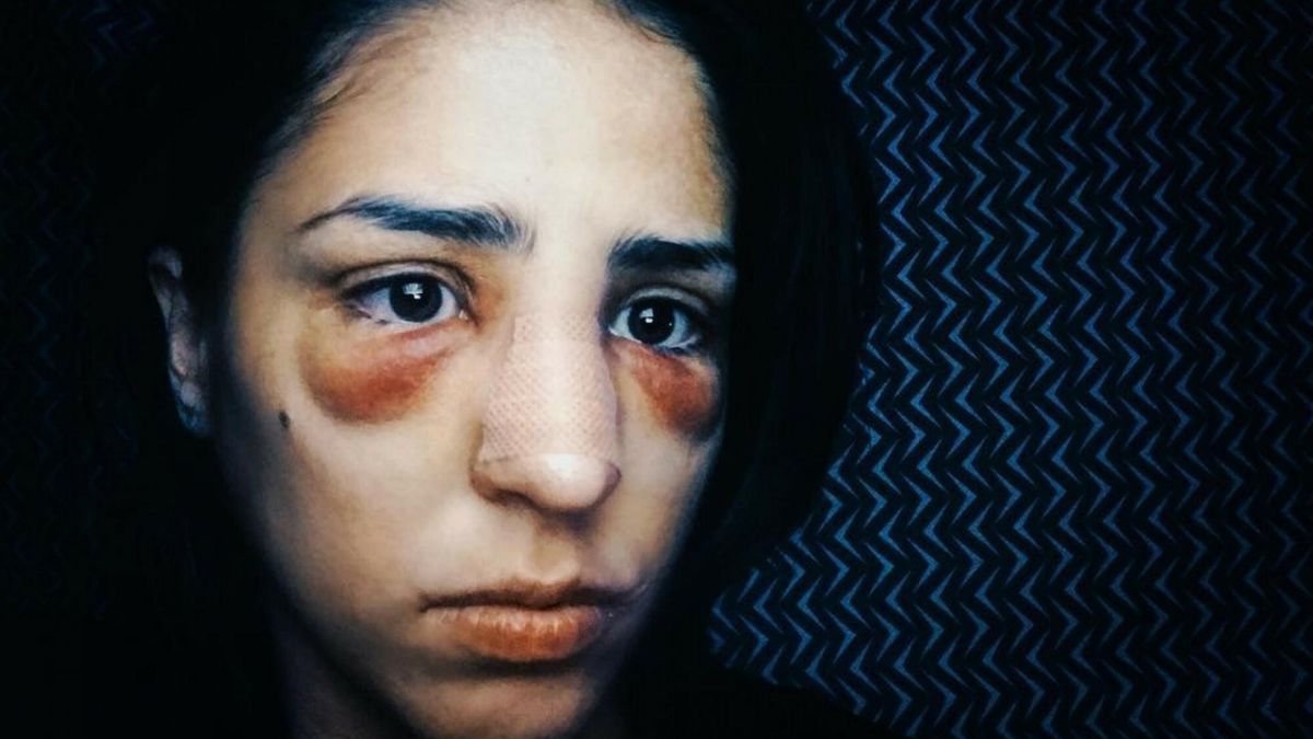 Christina doznała ciężkiej reakcji alergicznej na leki