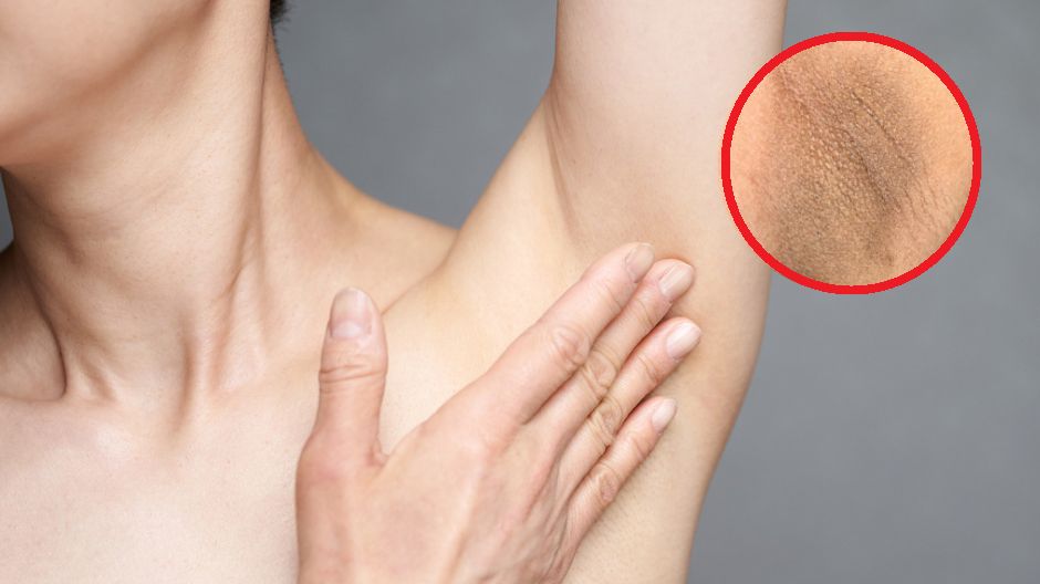 Rogowacenie ciemne najczęściej jest związane z zaburzeniami glikemii