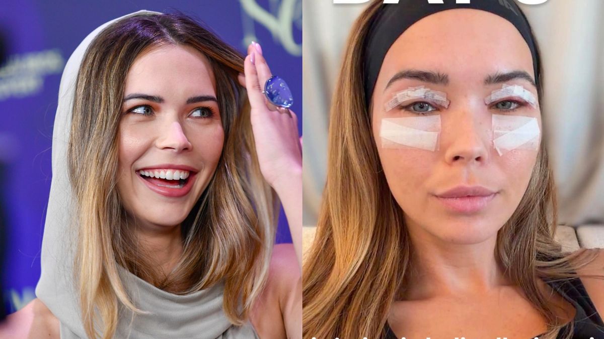 Sandra Kubicka prezentuje swoje lico 3 dni po OPERACJI POWIEK