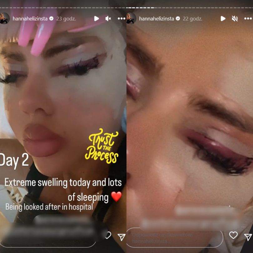 Uczestniczka brytyjskiego "Love Island" chwali się efektami operacji w tureckiej klinice
