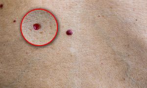 Czerwone plamki na skórze. To może być sygnał ostrzegawczy