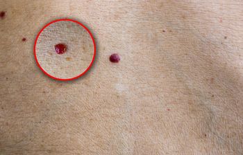 Czerwone plamki na skórze. To może być sygnał ostrzegawczy