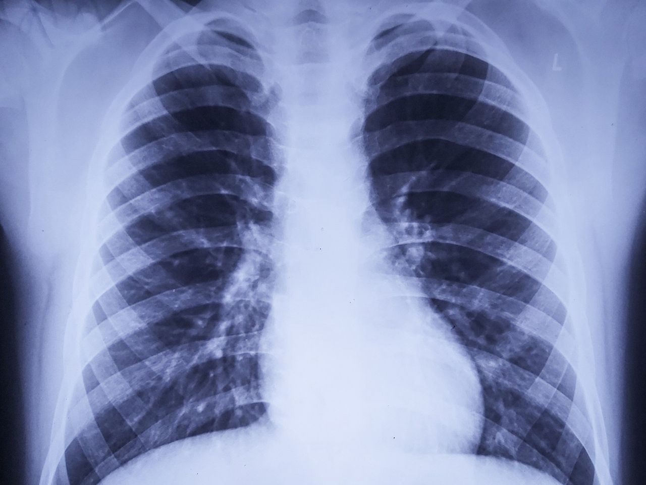 Koronawirus niewidoczny na zdjęciu RTG? Naukowcy: niektórzy zarażeni mają "czyste" płuca