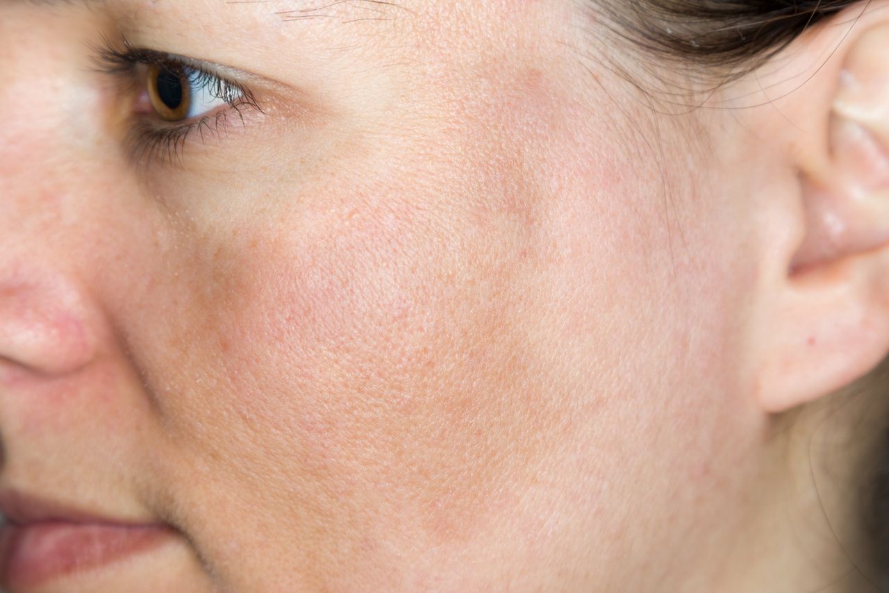 Natural solutions: Combat skin discolorations from your kitchen