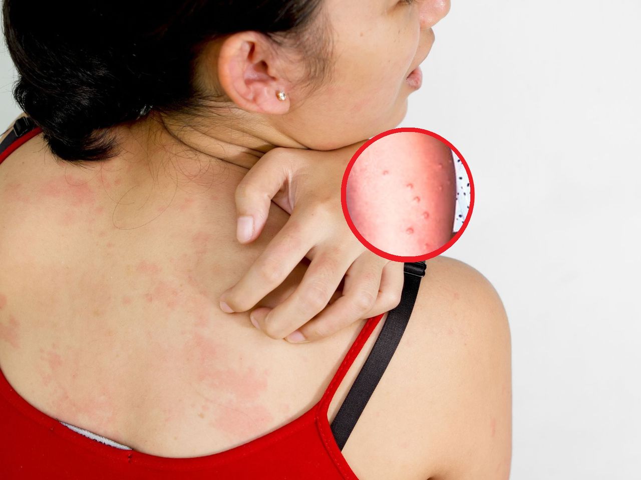 Basenowa wysypka. "Syn męczy się z tym od trzech lat"