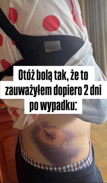 Michał Kempa miał duże siniaki