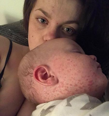 8-miesięczne niemowlę bardzo źle zniosło odrę