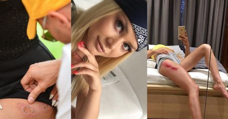 Ola Ciupa leczy się u Gojdzia! "Moje rany po wypadku na rolkach goją się"