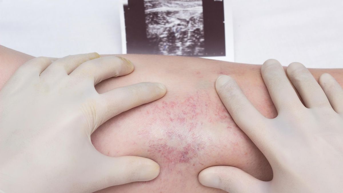 Co roku w Polsce umiera 30 tys. osób. Większość z nas wciąż niewiele wie na temat zakrzepicy