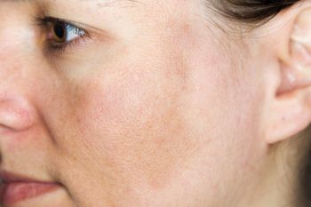 Wyciśnij i przetrzyj twarz. Stosuj regularnie, a plamy zaczną znikać