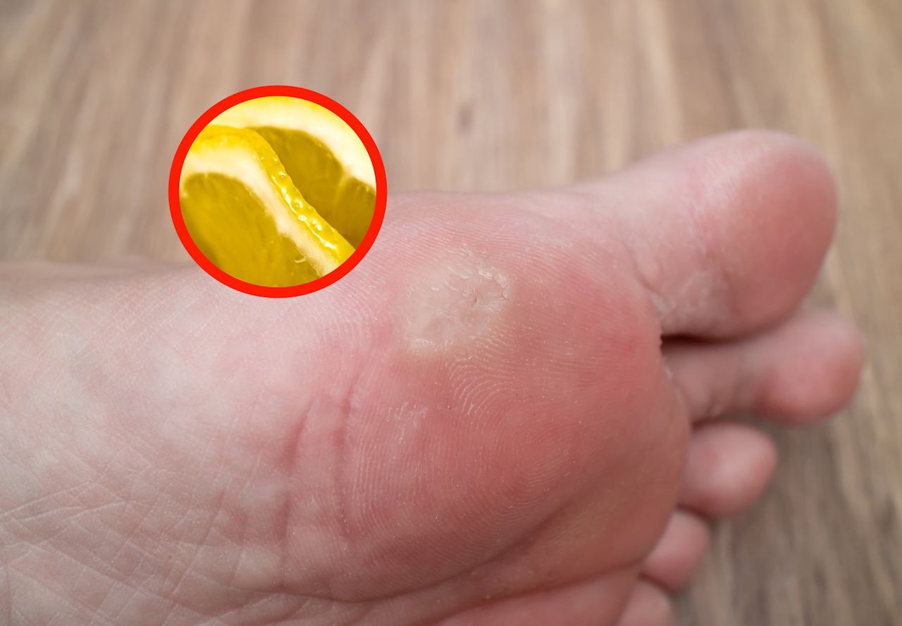 Lemon and chamomile: Simple home remedies for stubborn foot corns