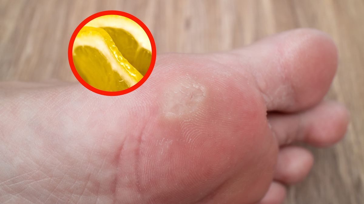 Co działa na odciski? Sprawdź sprawdzone sposoby