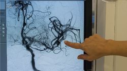 Udary po COVID-19. "U mnie na oddziale zmarło 40 proc. pacjentów"