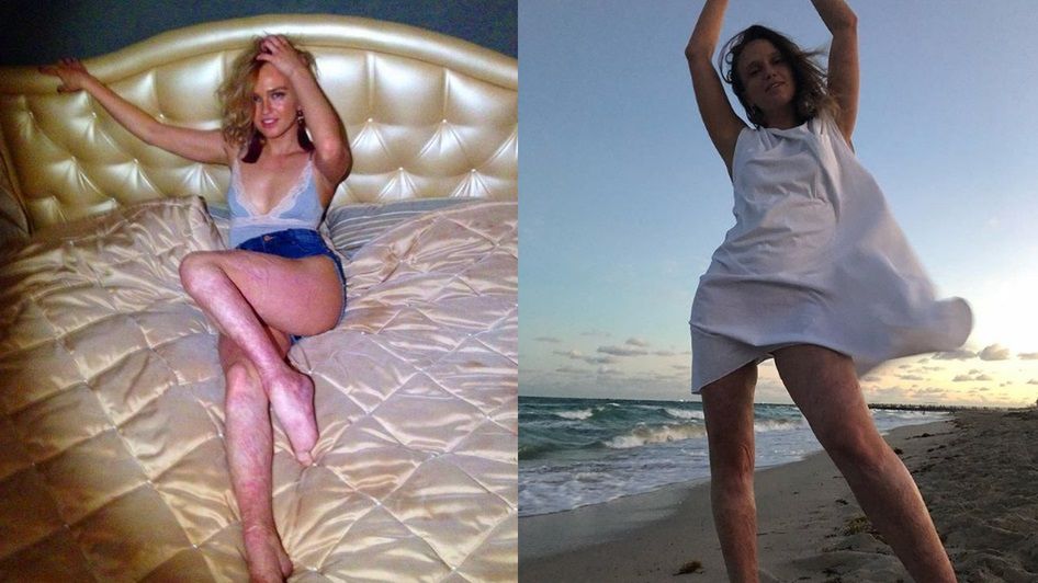 Kate Komleva doznała poparzeń 30 proc. ciała 