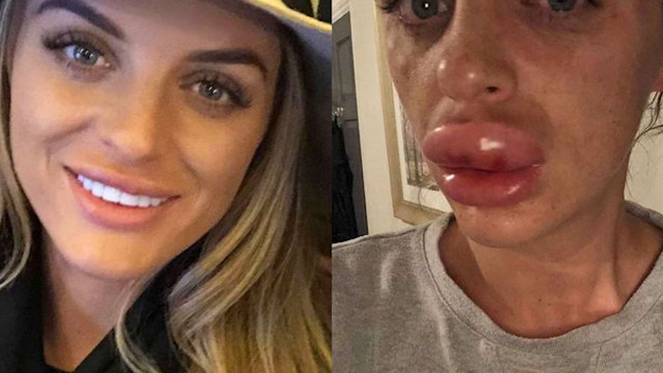 Nieudane wypełnianie ust