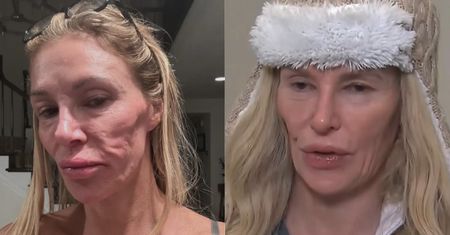 Brandi Glanville z żon "Żon Beverly Hills" ma problemy z twarzą po pęknięciu IMPLANTA PIERSI. Na leczenie wydała już ponad 700 tysięcy złotych