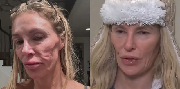 Brandi Glanville z żon "Żon Beverly Hills" ma problemy z twarzą po pęknięciu IMPLANTA PIERSI. Na leczenie wydała już ponad 700 tysięcy złotych