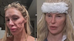 Brandi Glanville z żon "Żon Beverly Hills" ma problemy z twarzą po pęknięciu IMPLANTA PIERSI. Na leczenie wydała już ponad 700 tysięcy złotych