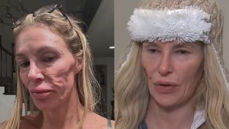 Brandi Glanville z żon "Żon Beverly Hills" ma problemy z twarzą po pęknięciu IMPLANTA PIERSI. Na leczenie wydała już ponad 700 tysięcy złotych