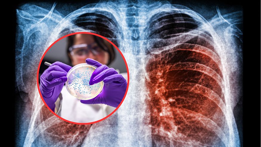 COVID może prowadzić do nieodwracalnych zmian w plucach