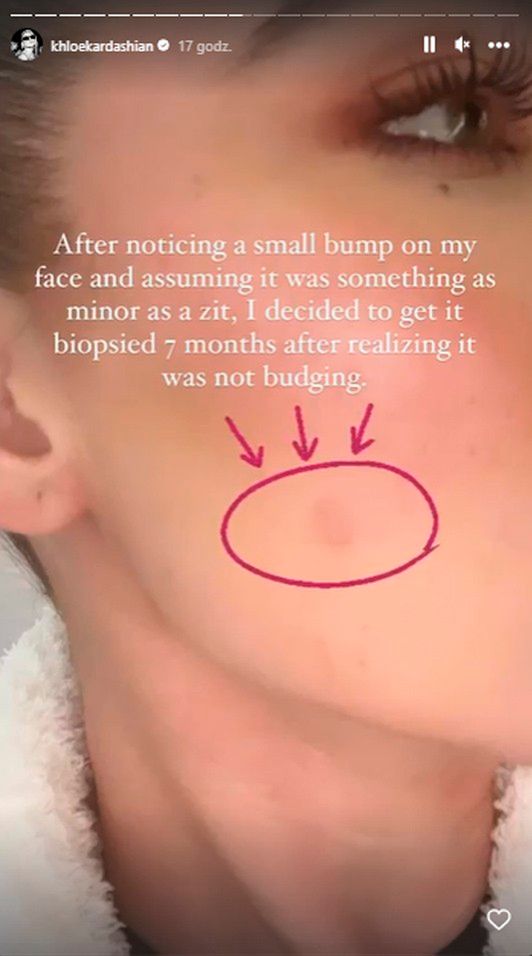 Khloe Kardashian zauważyła na policzku niewielki guzek